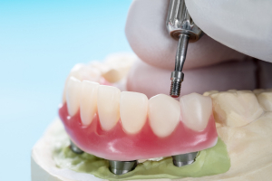 La rivoluzione delle protesi dentali fisse con impianti all-on-4