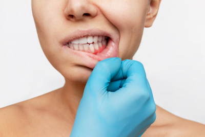 Sanguinamento delle gengive e parodontite: come curarsi per un sorriso sano