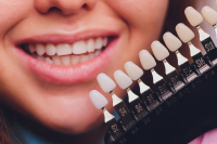 Denti più bianchi e allineati: il segreto delle faccette dentali