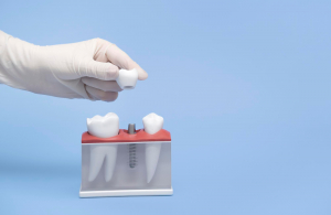 Tutte le possibilità di riavere i denti fissi: i diversi tipi di trattamento