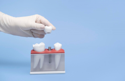 Tutte le possibilità di riavere i denti fissi: i diversi tipi di trattamento
