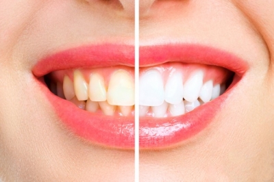 Sbiancamento dentale: tutto quello che hai sempre voluto sapere