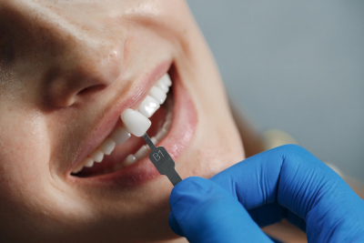 Niente più denti storti, scheggiati o spezzati e: una possibile soluzione sono le faccette dentali
