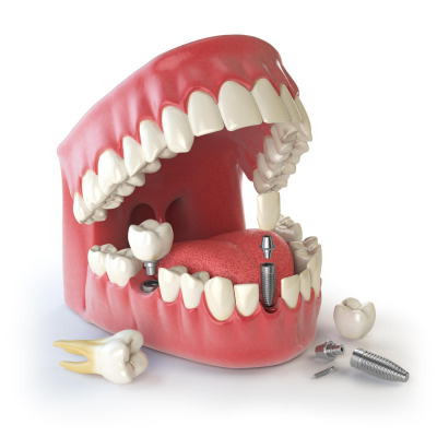 Mancanza di denti: implantologia dentale vicino Roma Eur Torrino