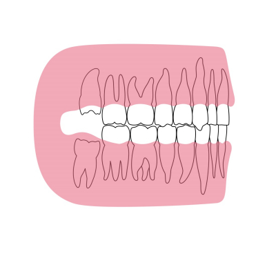 Estrazione dei denti del giudizio: le indicazioni per capire