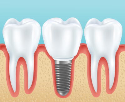 Impianti dentali in 24 ore a Roma