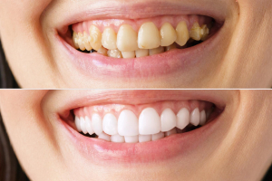 Estetica dentale a Roma: come migliorare il sorriso