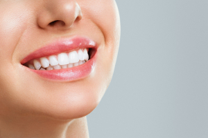 Faccette dentali: soluzione estetica a Roma