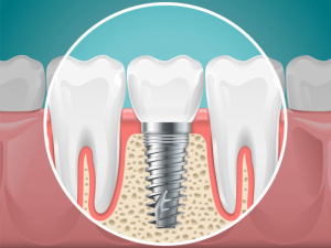 Gli impianti dentali sono dolorosi?