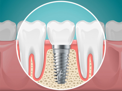 Gli impianti dentali sono dolorosi?