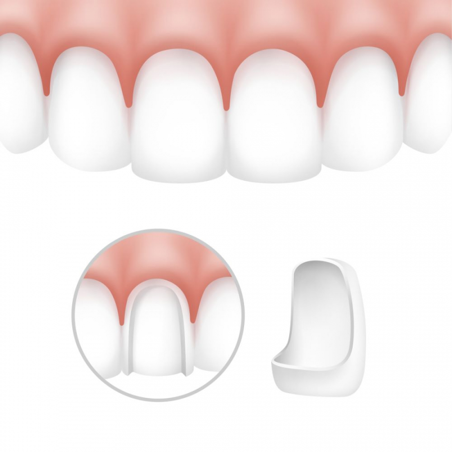 Cosa sono le faccette dentali e quando vengono utilizzate?